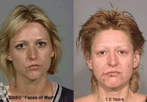 Meth-before-and-after- Changes meth addiction rehab Johannesburg