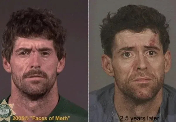 Meth before and after pics. Meth addiction rehab